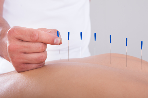 acupuncture needles